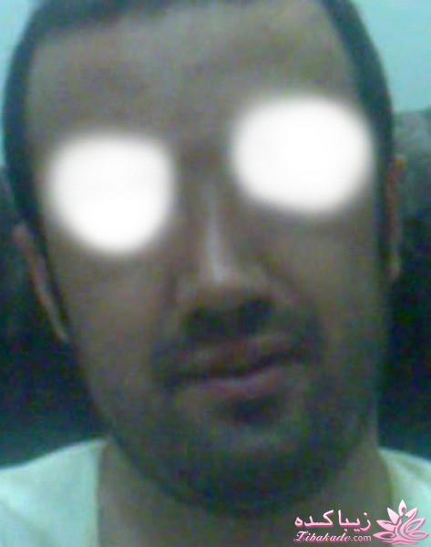 جراحی بینی - جراحی زیبایی